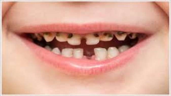 Çocuklar da Diş Çürüğü Neden Olur?