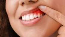 Düşük Bağışıklık Diş Eti Enfeksiyonlarına Sebep Oluyor!