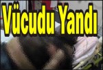 Vücudunu Yandı